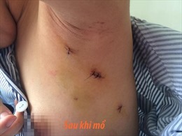 Ca mổ nội soi u xơ tuyến vú bằng phương pháp ‘Dr Luong’ đầu tiên thành công
