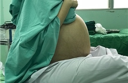  Người phụ nữ có khối u buồng trứng to hơn bụng của thai phụ chuẩn bị sinh