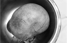 Người phụ nữ suýt tử vong vì khối u nang buồng trứng &#39;khổng lồ&#39; do sợ dao kéo