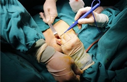 Lần đầu tiên, phẫu thuật lồng ngực có sử dụng máy tim phổi nhân tạo