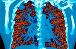 Hệ thống AI giúp phát hiện sớm ung thư phổi 