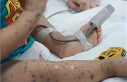 TP Hồ Chí Minh: Dịch bệnh tay chân miệng có xu hướng chững lại