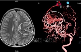 Cứu sống bệnh nhi bị dị dạng mạch máu não phức tạp hiếm gặp