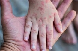 Canada ghi nhận ca tử vong đầu tiên do dịch sởi bùng phát trở lại