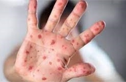 Cảnh giác với nguy cơ bệnh sởi &#39;trở lại toàn cầu&#39;