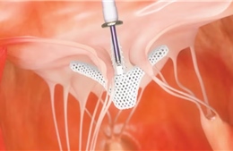 Chữa hở van tim ba lá bằng công nghệ TriClip - dấu mốc quan trọng trong y học châu Phi