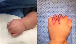 Tách ngón tay cho bé người Campuchia bị hội chứng dính ngón bẩm sinh