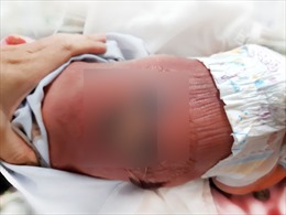 Sưởi ấm bằng than, một trẻ sơ sinh bị bỏng nặng, nhiễm trùng máu