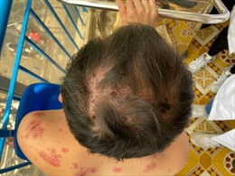 TP Hồ Chí Minh: Phát hiện một trường hợp mắc bệnh lý hiếm gặp, dễ nhầm với bệnh lý dị ứng thuốc