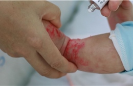 TP Hồ Chí Minh: Trẻ khám bệnh tăng do bị viêm da cơ địa bội nhiễm 