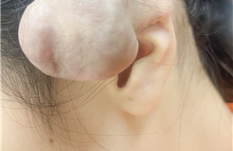 Xỏ khuyên, bấm nhiều lỗ trên vành tai dễ dẫn đến nhiều hệ luỵ