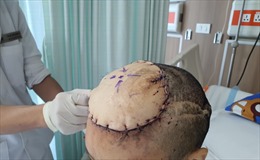 Khối u ác tính khổng lồ có hình dáng như quả hồ lô mọc trên đầu nữ bệnh nhân