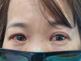 Người bệnh đau mắt đỏ cần làm gì và những lưu ý khi sử dụng thuốc nhỏ mắt