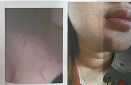 TP Hồ Chí Minh: Nữ sinh lớp 12 bị phụ huynh của bạn đánh gây thương tích