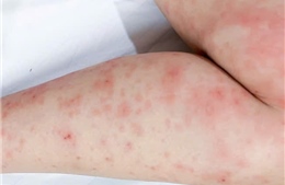 Cảnh báo gia tăng các bệnh về da trong mùa mưa 