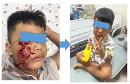 Cấp cứu bé trai 5 tuổi bị chó cắn rách mặt phải khâu 20 mũi 
