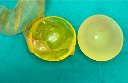 Việt kiều về nước tình cờ phát hiện rách túi ngực sau 20 năm phẫu thuật thẩm mỹ
