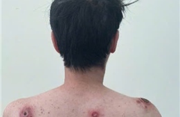  Bệnh giang mai gia tăng trở lại, cảnh báo nguy cơ ở nhóm quan hệ đồng giới