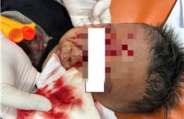 Bé trai bị chó béc-giê cắn rách mặt, bệnh viện huy động 3 chuyên khoa phẫu thuật khẩn cấp
