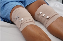 Ứng dụng keo PRF, bước tiến mới trong điều trị bệnh thoái hoá khớp gối
