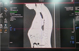 Phẫu thuật thành công ca dị dạng lồng ngực hiếm gặp cho thanh niên người Campuchia 