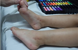 TP Hồ Chí Minh có 35.440 ca mắc tay chân miệng