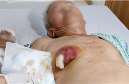 Nam giới vẫn có nguy cơ mắc ung thư vú và thường phát hiện muộn