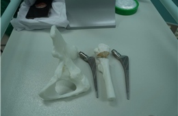 Ứng dụng in 3D phẫu thuật thành công ca loạn sản khớp háng hiếm gặp