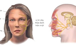 Nhiễm lạnh đột ngột có thể gây liệt mặt, méo miệng