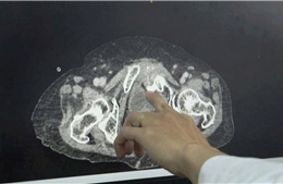 Cứu sống cụ bà bị vỡ bàng quang trong phúc mạc tự phát hiếm gặp