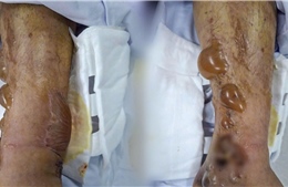 Bác sĩ cảnh báo tự đắp thuốc lá chữa chấn thương có thể gây nhiễm trùng nặng