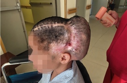 Cô gái 33 tuổi đột quỵ, khuyết sọ diện rộng sau hút mỡ, cấy mỡ làm đẹp