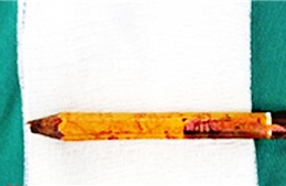 Bút chì đặt trên ghế đâm xuyên mông bé trai, ngập sâu 8cm