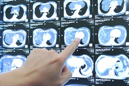 Bóc thành công khối u mỡ hơn 4 kg gây chèn ép phổi của người bệnh