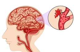 Kiểm tra bệnh viện quảng cáo kỹ thuật lọc máu công nghệ cao để giảm nguy cơ đột quỵ