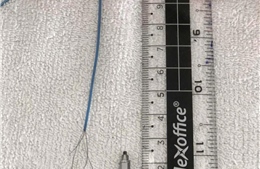 Ho nhiều, cụ ông đi khám phát hiện dụng cụ nha khoa rơi vào phế quản