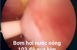 Ứng dụng kỹ thuật 'bốc hơi nước' điều trị phì đại tuyến tiền liệt