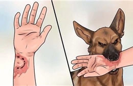 Bác sĩ hướng dẫn sơ cứu khi trẻ bị chó mèo cắn