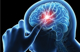 Cảnh báo nguy cơ đột quỵ từ dấu hiệu đau đầu