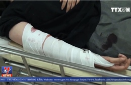 Phẫu thuật nối cánh tay cho nạn nhân vụ lật xe trên đèo Hải Vân