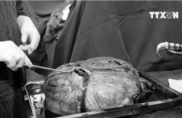 Phẫu thuật khối u 30kg cho cụ bà gần 80 tuổi