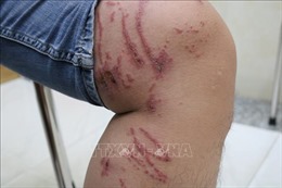 Hà Nội: Số người viêm da nặng do tiếp xúc với kiến ba khoang tăng mạnh