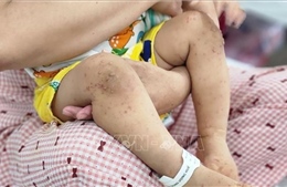 Số trẻ mắc bệnh tay chân miệng tăng gấp 3,5 lần so với cùng kỳ năm trước