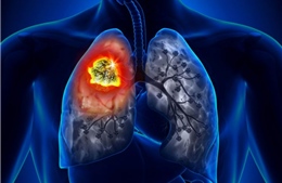 Ứng dụng trí tuệ nhân tạo hỗ trợ chẩn đoán ung thư phổi