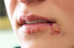 Nghiên cứu về nguồn gốc căn bệnh viêm da phổ biến do nhiễm virus herpes