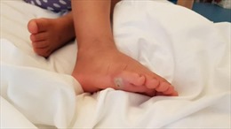 Chân trần thử giày mới, bé gái 4 tuổi bị nhiễm trùng máu suýt chết