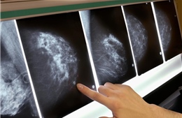AI giúp sàng lọc ung thư vú tốt hơn các phương pháp hiện hành?