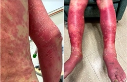 Một người bị tróc da, đỏ bầm tay chân sau tiêm vaccine Johnson & Johnson