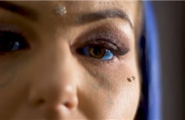 Cô gái nghiện xăm bị mù vì tiêm xanh nhãn cầu