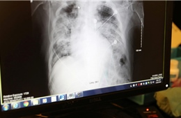 Bệnh nhân Mỹ tử vong sau khi được ghép phổi của người nhiễm virus SARS-CoV-2